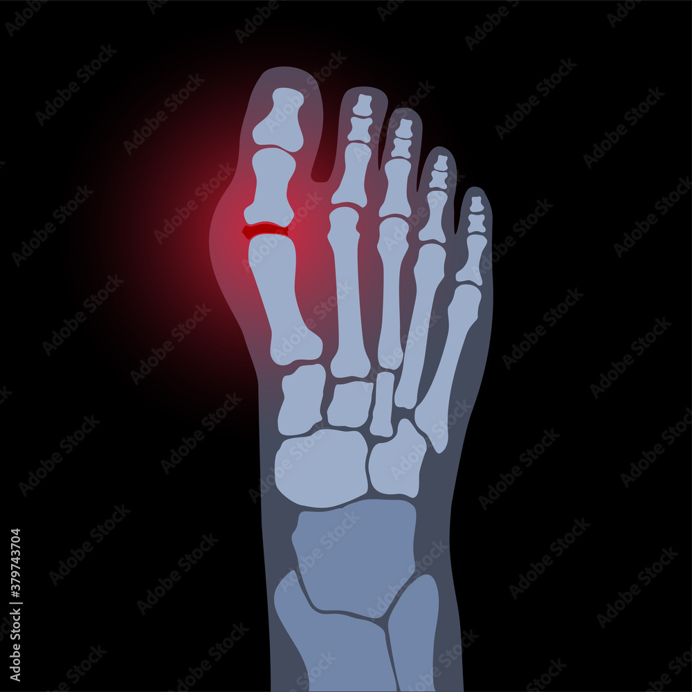Fototapeta premium Arthritis foot concept