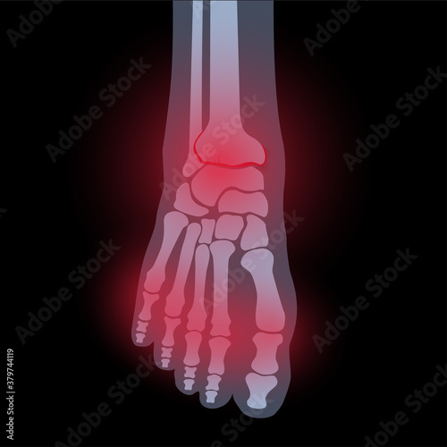 Arthritis foot concept