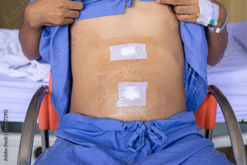 Patient man showing sticking plaster patched surgery wound on stomach after surgical