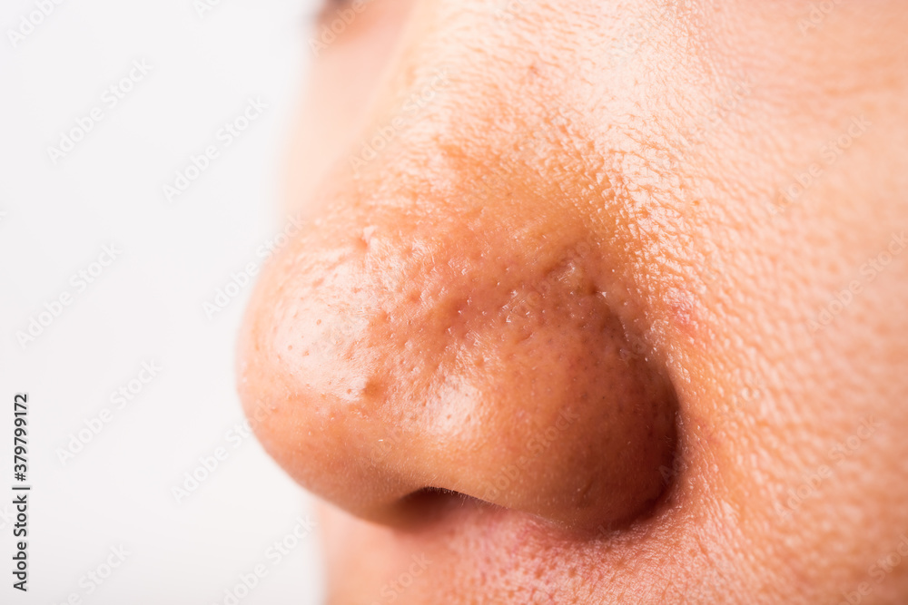 Obraz premium Woman large pores have freckles cheek oily, acne pimple on nose