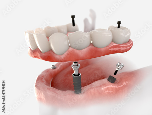 Mandibular fixed restoration with 4 implants.  3d illustration of implant on white background.