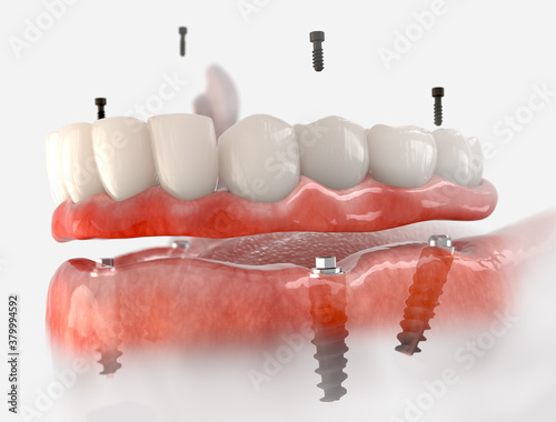 Foto Mandibular fixed restoration with 4 implants