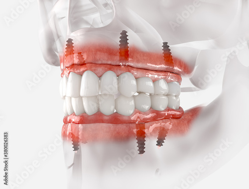 Mandibular and Maxillary prosthesis