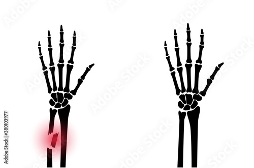 Fracture x ray concept