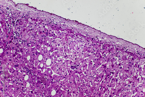 human liver tissue showing fatty degeneration photo