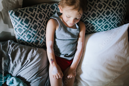 a little boy with calamine lotion on the poison ivy on his arms photo