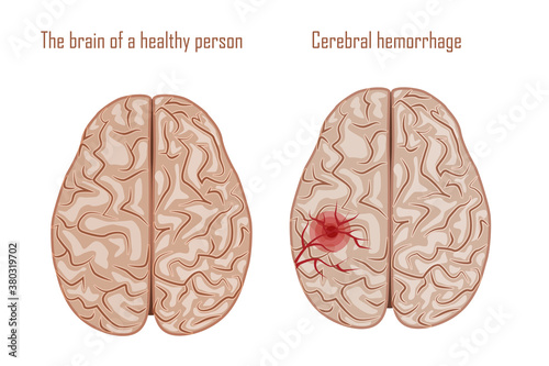 Human brain. Diseases of the brain, nervous system. Vector illustration