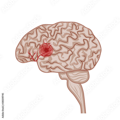 Human brain. Diseases of the brain, nervous system. Vector illustration