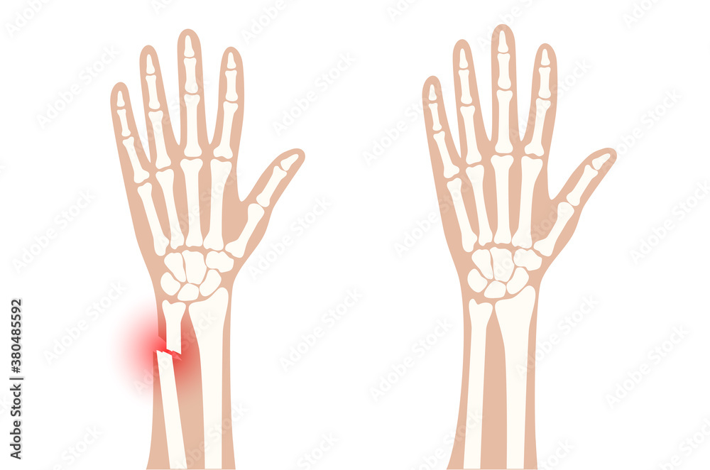 Obraz premium Fracture x ray concept