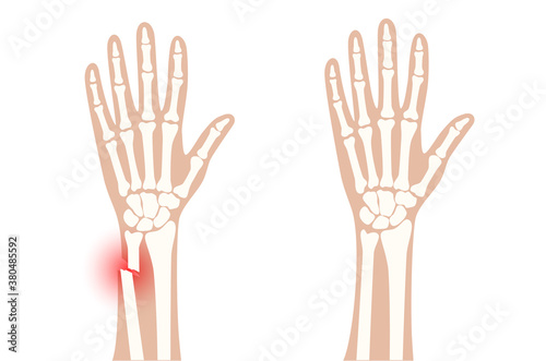 Fracture x ray concept