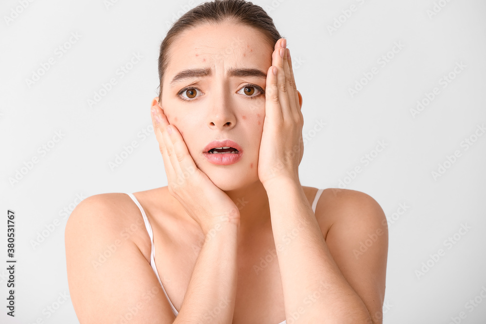 Young woman with acne problem on light background Young woman with acne problem on light background