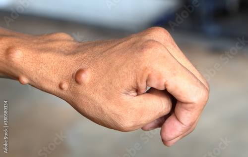 Neurofibromatosis Formed on the hands and arms photo
