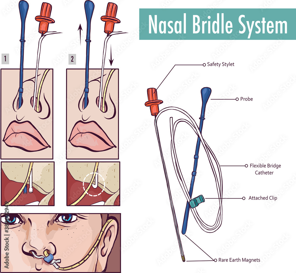 A nasal bridle attaching a nasogastric tube to the nasal septum to