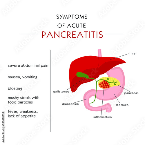 pancreatitis symptoms, inflammation of the pancreas. vector illustration