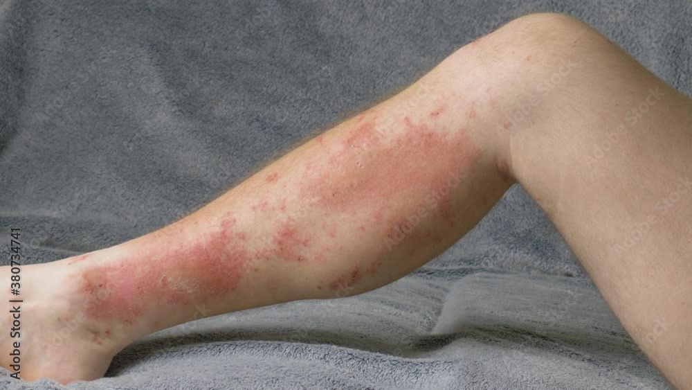 Large serious skin rash on leg. Poison sumac reaction covering lower leg. Itchy red welts and sores caused by chemical urushiol, found in poison oak and poison ivy as well. Large serious skin rash on leg. Poison sumac reaction covering lower leg. Itchy red welts and sores caused by chemical urushiol, found in poison oak and poison ivy as well.