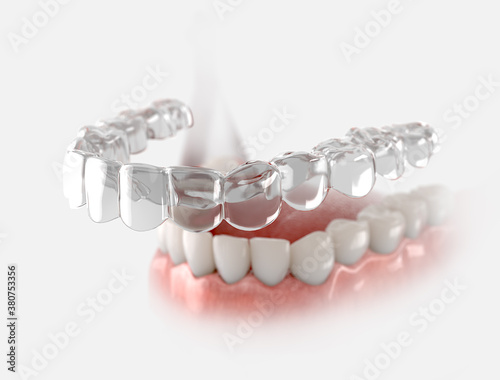 Transparent retainer fixed on lower jow.