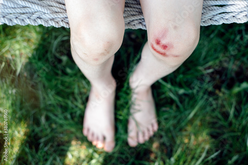 Little boy's skinned knee is smiling