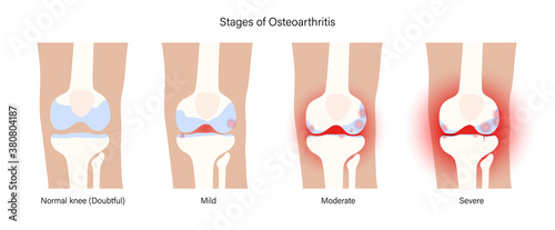 Arthritis in knee joint