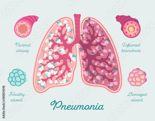 Pneumonia in lung of human. Inflammation lung - hand drawn illustration. Airway, bronchiole and alveoli filled by mucus. Patient-friendly diagram of COVID-19 Pneumonia. Comparing with healthy lungs