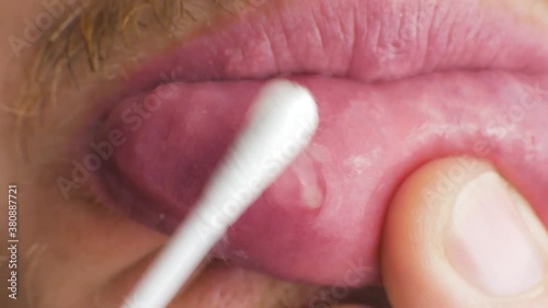 putting healing gel ointment on an aphtha oral inflammation on the gums with a cotton swab CLOSE UP
