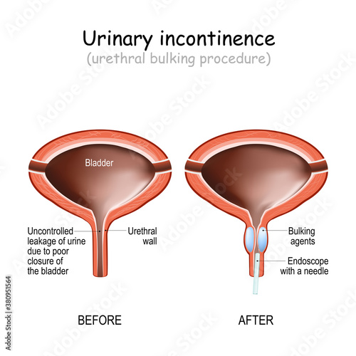 Human urinary bladder, and Urethral bulking procedure with endoscope