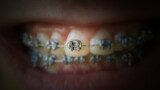 Teeth with braces or braces in an open human mouth. Selective focus on one bracket. Dental care. Straightened teeth.