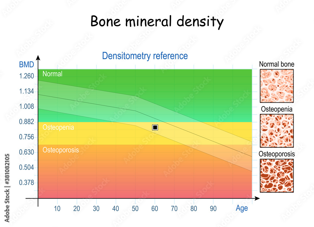 Bone mineral. Минеральная плотность костей BMD. Снижение плотности костной ткани по BMD. BMD денситометрия Результаты. Минеральная плотность костной Пиковая.