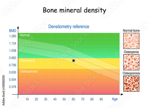 Densitometry reference. Osteopenia and osteoporosis. Aging process