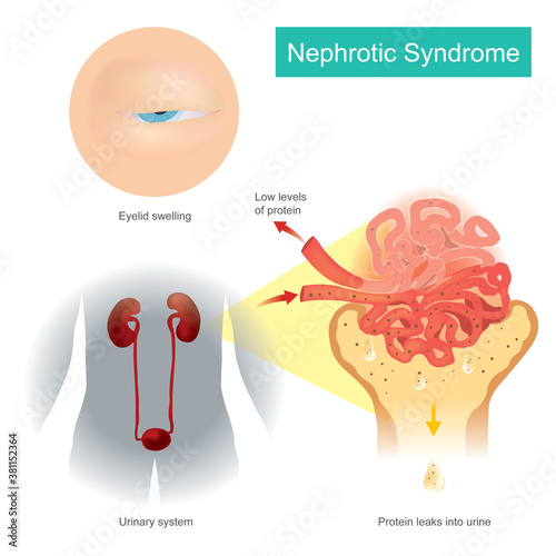 Nephrotic Syndrome. Illustration explain A kidney disorder that causes your body to pass too much protein in your urine or pee..