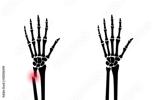 Fracture x ray concept
