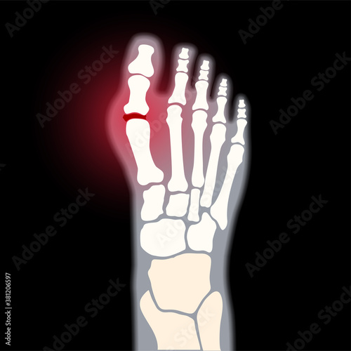 Arthritis foot concept
