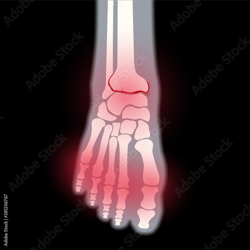 Arthritis foot concept
