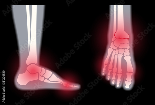 Arthritis foot concept