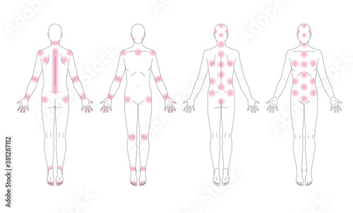 人体の痛みなどが出る場所。性別無しの略図.