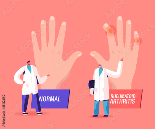 Rheumatoid Arthritis Sickness Concept. Doctor Arthrologist Point on Huge Hand with Joints Disease to Colleague Concilium