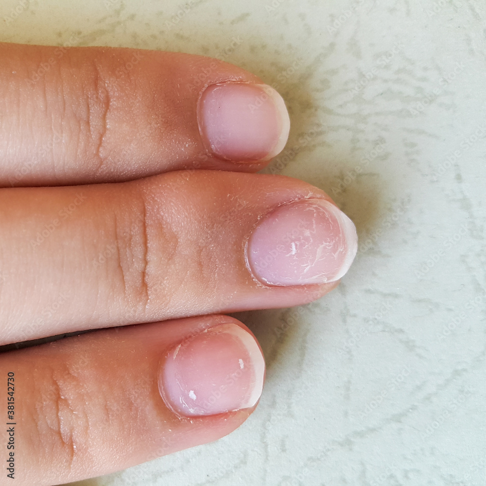 A bulge appeared on the tip of the student's middle finger due to the fact that he used the pen too often. Deformity and callus of the finger. A bulge appeared on the tip of the student's middle finger due to the fact that he used the pen too often. Deformity and callus of the finger.
