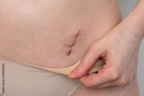 Person shows on belly scar from a appendix, closeup