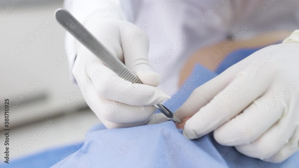 Surgery mole removal by dermatologist 60 fps Stock Video | Adobe Stock