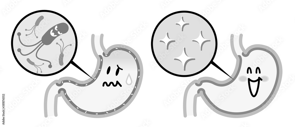 ピロリ菌に感染した胃と健康な胃 モノトーン ピロリ菌に感染した胃と健康な胃 モノトーン