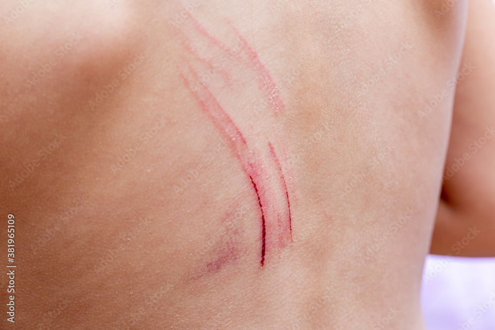 Fototapeta premium Wounds scratches on the back of a small child close up