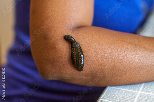 Foto treating tennis elbow with leeching