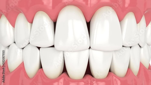 Human jaw with open gingival embrasure