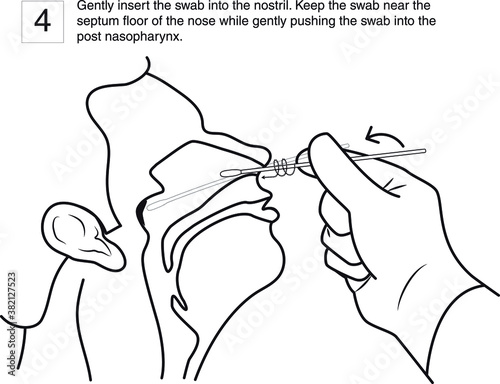 Gently insert the swab into the nostril. Keep the swab near the septum floor of the nose while gently pushing the swab into the post nasopharynx. step 4, line drawing