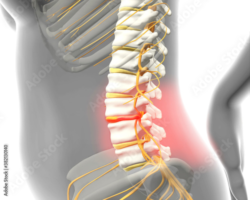 Spinal disc herniation causing lower back pain, 3d illustration photo