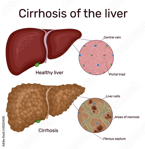 Illustration of chronic liver disease cirrhosis. Depicted is a healthy and diseased liver
