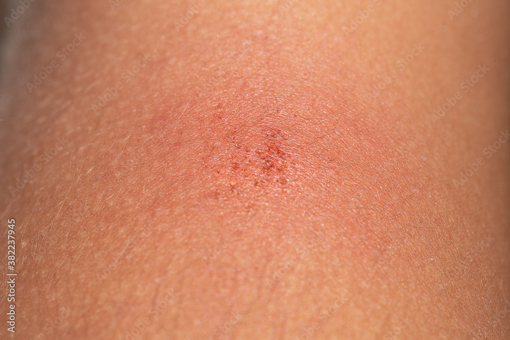 Symptoms of an eczema on the skin of a young woman