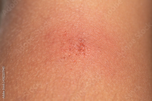 Symptoms of an eczema on the skin of a young woman