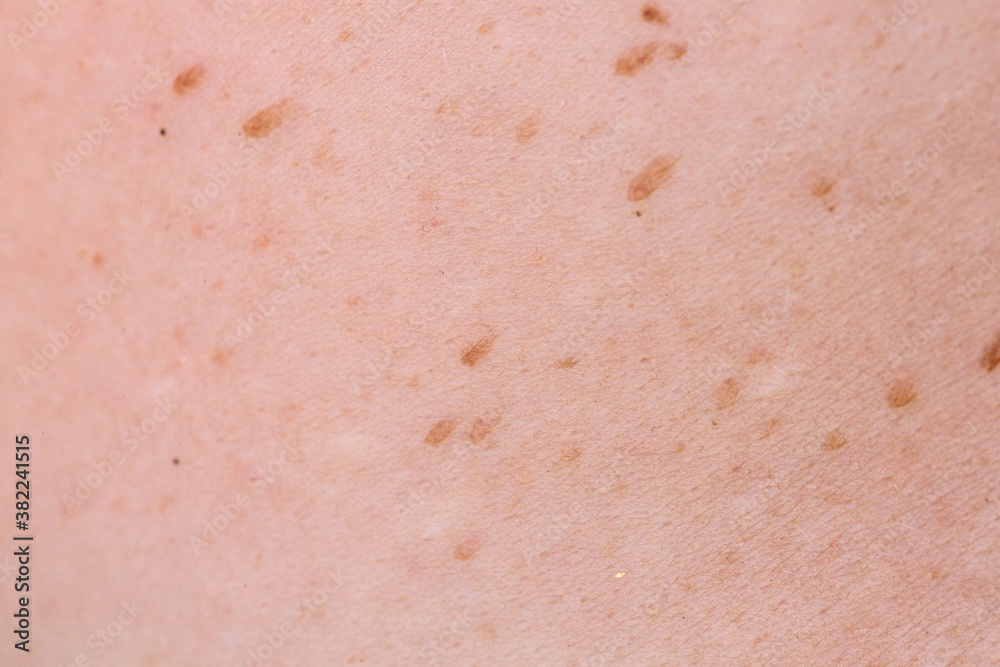 Fototapeta premium Spots on the skin due to sun exposure with risk of melanoma formation
