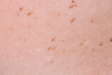 Spots on the skin due to sun exposure with risk of melanoma formation