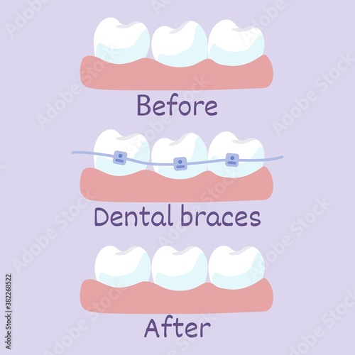 Stages of teeth alignment, before and after correction with brackets Correction of teeth with orthodontic braces Vector illustration in flat style